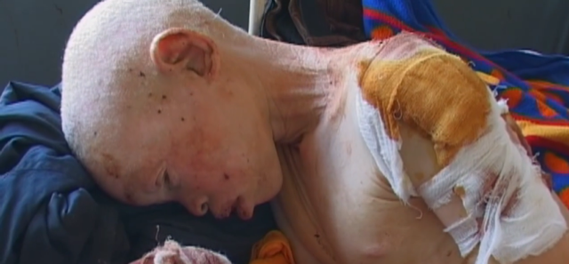 un bambino albino ferito